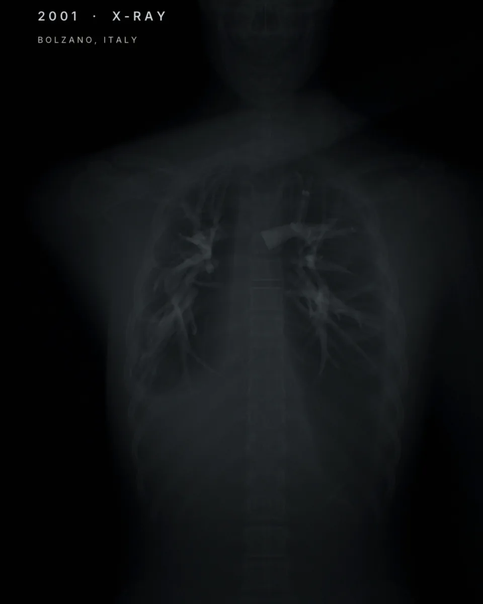 Reconstruction of a chest X-ray: the ribs, spine and lungs in grey on black, with the shoulders at the top.
